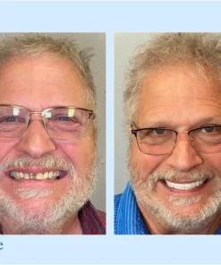 VivaDenta™ - Premium Denture