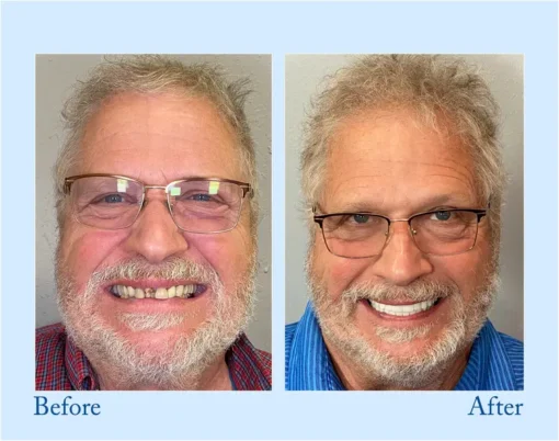 VivaDenta™ - Premium Denture