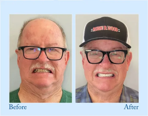 VivaDenta™ - Premium Denture
