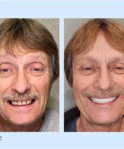 VivaDenta™ - Premium Denture