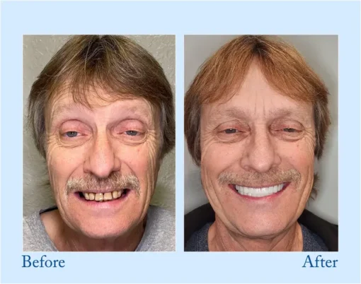 VivaDenta™ - Premium Denture