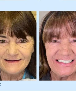 VivaDenta™ - Premium Denture