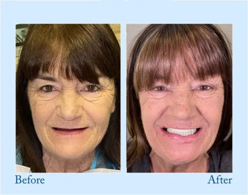 VivaDenta™ - Premium Denture