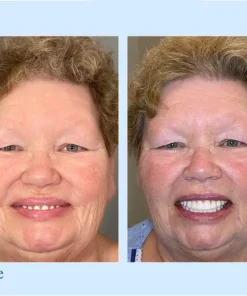 VivaDenta™ - Premium Denture
