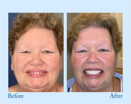VivaDenta™ - Premium Denture