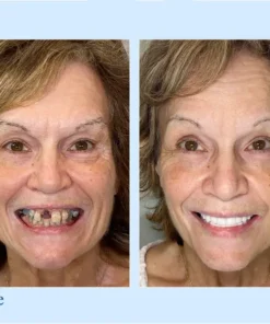 VivaDenta™ - Premium Denture